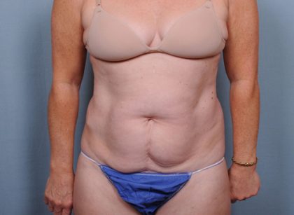 Abdominoplasty Before & After Patient #1685