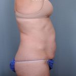 Abdominoplasty Before & After Patient #1685