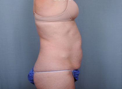 Abdominoplasty Before & After Patient #1685