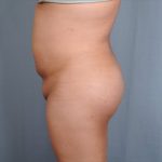 Brazilian Butt Lift Before & After Patient #1686