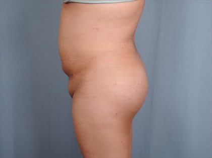 Brazilian Butt Lift Before & After Patient #1686