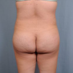 Brazilian Butt Lift Before & After Patient #1686