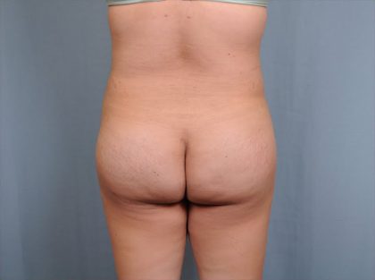 Brazilian Butt Lift Before & After Patient #1686