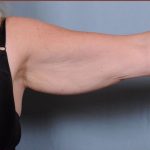 Brachioplasty Before & After Patient #1848