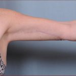 Brachioplasty Before & After Patient #1848