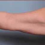 Brachioplasty Before & After Patient #1847