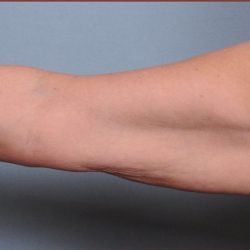 Brachioplasty Before & After Patient #1847