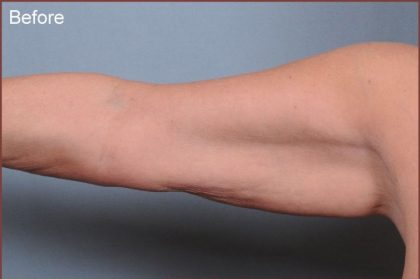 Brachioplasty Before & After Patient #1847