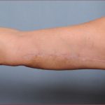 Brachioplasty Before & After Patient #1847
