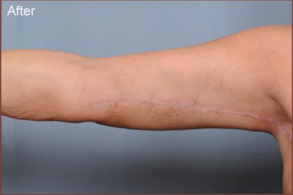 Brachioplasty Before & After Patient #1847