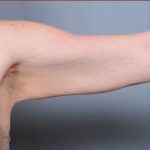 Brachioplasty Before & After Patient #1846