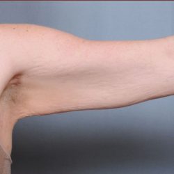 Brachioplasty Before & After Patient #1846