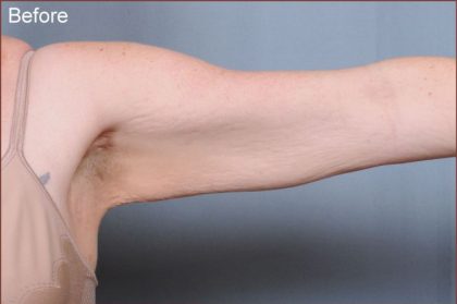 Brachioplasty Before & After Patient #1846