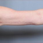 Brachioplasty Before & After Patient #1846