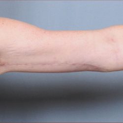 Brachioplasty Before & After Patient #1846