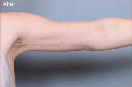 Brachioplasty Before & After Patient #1846