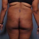 Brazilian Butt Lift Before & After Patient #1845