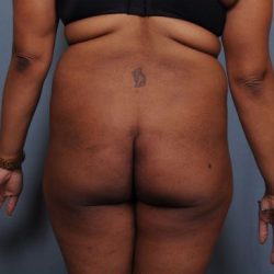Brazilian Butt Lift Before & After Patient #1845