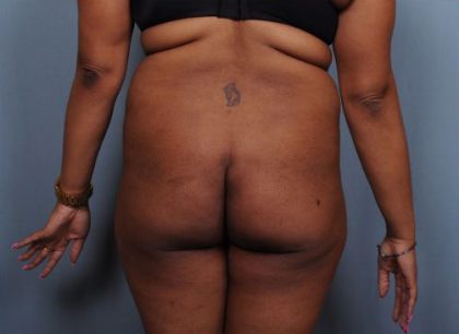 Brazilian Butt Lift Before & After Patient #1845