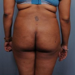 Brazilian Butt Lift Before & After Patient #1845