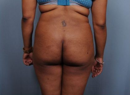 Brazilian Butt Lift Before & After Patient #1845