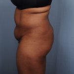 Brazilian Butt Lift Before & After Patient #1845