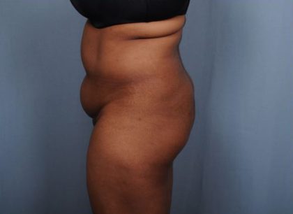 Brazilian Butt Lift Before & After Patient #1845