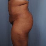 Brazilian Butt Lift Before & After Patient #1845