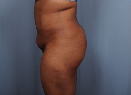 Brazilian Butt Lift Before & After Patient #1845