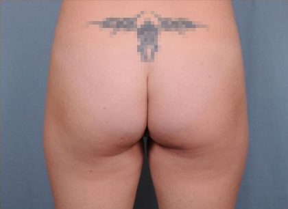 Brazilian Butt Lift Before & After Patient #1844