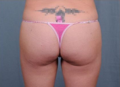 Brazilian Butt Lift Before & After Patient #1844