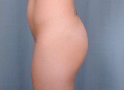 Brazilian Butt Lift Before & After Patient #1844
