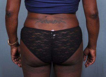 Brazilian Butt Lift Before & After Patient #1843