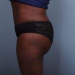 Brazilian Butt Lift Before & After Patient #1843