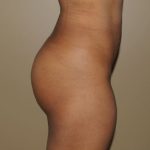Brazilian Butt Lift Before & After Patient #1842