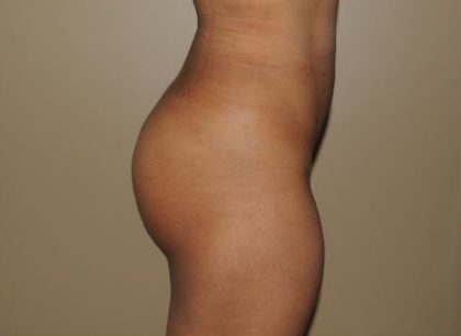 Brazilian Butt Lift Before & After Patient #1842