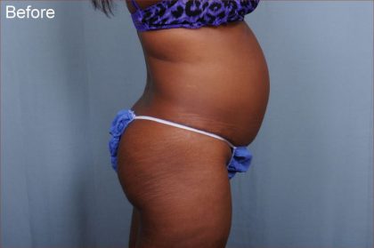 Brazilian Butt Lift Before & After Patient #1840