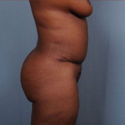 Brazilian Butt Lift Before & After Patient #1840