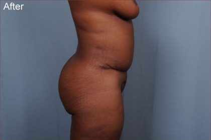 Brazilian Butt Lift Before & After Patient #1840