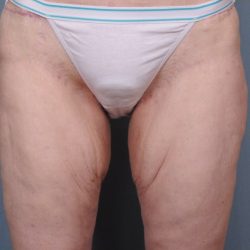 Thigh Lift Before & After Patient #1839