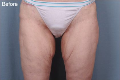 Thigh Lift Before & After Patient #1839