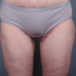 Thigh Lift Before & After Patient #1839