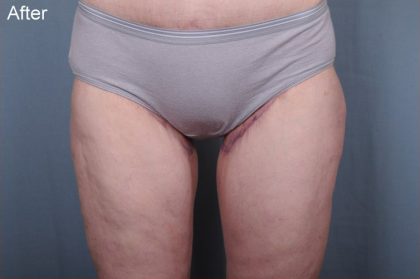 Thigh Lift Before & After Patient #1839