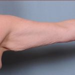 Brachioplasty Before & After Patient #1852