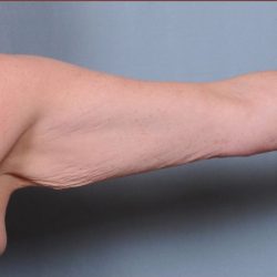 Brachioplasty Before & After Patient #1852