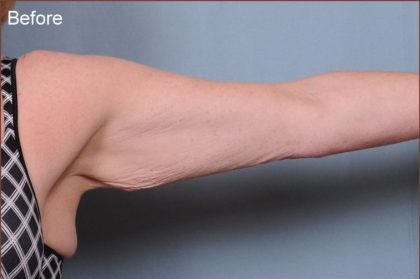Brachioplasty Before & After Patient #1852