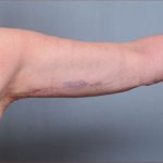 Brachioplasty Before & After Patient #1852