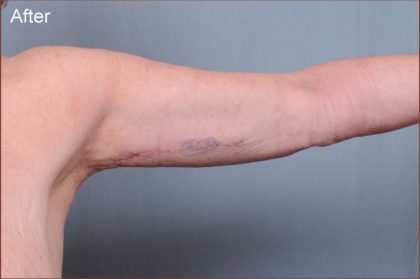 Brachioplasty Before & After Patient #1852