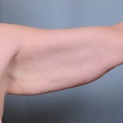 Brachioplasty Before & After Patient #1851