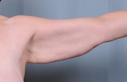 Brachioplasty Before & After Patient #1851